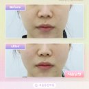 동안의원 | 서울동안의원 실리프팅 후기 | 땅콩형 얼굴 개선한 20대 여성 사례