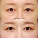 에이엠통상 | 눈재수술 45. [매몰쌍수 한달, 멍, 세수, 가격, 자연유착 5일차-1주일, 눈밑지방재배치 수술방법, 경과...