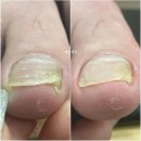 풀리메디시흥월곶점네일박스 | 시흥 월곶 내성발톱 무좀발톱 발톱무좀 발각질 효과적인 관리 네일박스