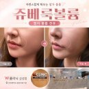 더더블유의원 | W클리닉 삼성점에서 쥬베룩볼륨으로 팔자주름 극복한 후기