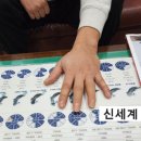 여러 손가락 절단 시 착용하는 맞춤형 실리콘 손가락 의수 [신세계 의수족 연구소]