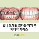 일등치과의원 | 사가정치과 20년 전 만든 오래된 크라운, 입냄새 나는 느낌이라면?