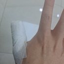 부강외과의원 | 대구 부강외과 화상치료 후기(feat. 추감기 부상)