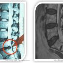 [허리디스크/척추관협착증] 허리디스크와 척추관협착증의 증상/치료/질환 비교 이미지