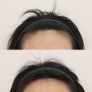 美 헤어라인 - 부산진구 | 잠실 잠실새내 두피문신 자연스러운 헤어라인 후기