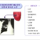 폐농양 이미지