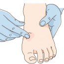 사마귀와 티눈 구별법, 집에서 손톱깍이로 뜯으면 안 되는 이유 이미지