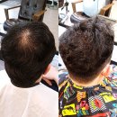 장수케어 | 정수리탈모커버 볼륨과 생장 동시에 수원바버샵 이씨바버샵의 모백생장술 링거펌 케어 후기