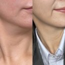 천호온사랑치과의원 | 천호역피부과 얼굴형 윤곽관리 "이중턱 뿌시기" 인모드FX + 지방분해주사 /보톡스 후기