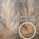 문신양계장 | 시흥 신천동 가까운두피관리샵 여성숱부족은 생장술과 두피문신