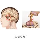 뇌하수체 종양 , 뇌하수체 호르몬 변화 (선종, 기능저하증) 이미지