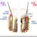 치주염 - 치주염 (잇몸병, 풍치) 이미지