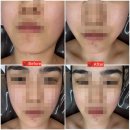 모아뷰티 | 대전이중턱리프팅 관리 후기, 하이푸 잘하는 에스테틱 추천 [뷰티모아]