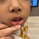 입안 입술 수포, 부산 점액낭종 제거 후기(구내염X 수족구X)