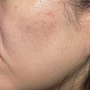 기계한의원 | 노원역 피부과 추천 한의원 여드름흉터시술 새살침 후기