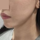 안면종합공사 | 심부볼지방제거, 안면거상술이 가장 효과적일 수 밖에 없는 이유 (+후기, 비용)