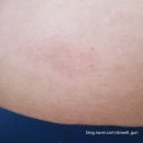 희망반점 | [마운자로 2.5mg 한 달 후기] 85kg→82.6kg 감량과 '붉은 반점' 부작용 기록 (내돈내산)