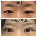 대구듀얼트임후기/대구성형외과/대구듀얼트임/대구...앞트임/윗트임/비절개/눈매교정 /사방트임/쌍수 후기