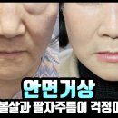 볼살 처짐, 심부볼, 팔자주름까지 개선하는 법?! 안면거상 수술 전후 정밀 비교 이미지