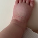 볼지메디 | 아기 습진 힐더메디 시카라놀린크림 2주차 그만 두려는 이유(솔직후기)