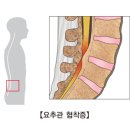 척추관 협착증(Lumbar spinal stenosis) 이미지