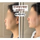 연세명인병원 | 원주 이중턱 리프팅 브이로 하이푸로 끌어올려준 연세명인병원미클라인