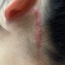 30대 갑상선암 충북대병원 진단부터 수술까지 후기 (4) - 수술 후 9개월 경과