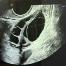 수정-2 | 다낭성난소증후군 인공수정 2차 후기