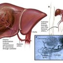 간암 환자의 색전술이란 무엇인가? 이미지
