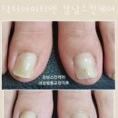 케어네일 이미지