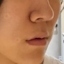 스컬트라 6회차 내돈내산 후기 | 팔자 옆볼패임 어디가 더 효과 좋았을까? (+1년 누적 경험담)