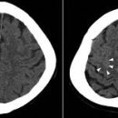 재발성 다발 연골염[relapsing polychondritis] 이미지