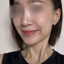 디자인콜라쥬 | 천호피부과 콜라쥬볼륨으로 땅콩형 얼굴 탈출, 앞볼 옆볼 팔자 꺼짐 효과 솔직후기(+통증, 효과)