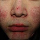 메디컬오한의원 대구점 | 대구주사피부염 치료받아도 자꾸 반복된다면 봐야할 3가지