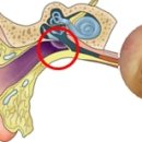 이명 (Tinnitus)ㅡ이루증 (Otorrhea) 이미지