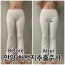 (주)이주데코 | 안양범계 허벅지 무한람스 한달간 변화(+멍 붓기 티 안나게 옷 입는 법)