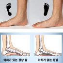 다율동 바디윤필라테스, 발목 아치무너짐 재활 후기