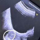 분당삼평-D-9 | 분당제일여성병원 배아이식 동결이식1차 (4) : 동결이식 4일배아 2개 이식/ 눈물의 이식 후기