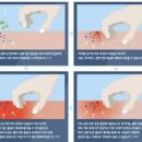 피부 아토피 원인 증세 보습 낫는법 예방 약 성인 아토피 피부염 이미지