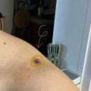 그리니피부과의원 | 사당역피부과 그리니피부과의원 양성종양 섬유종 염증주사