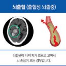 심뇌혈관 종류 예방 심뇌혈관 나이 알아보려면. 이미지