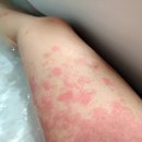 더레드피부과의원 | 탈스테로이드 후기 +35 :: 아토피, 지옥 같은 스테로이드 리바운딩