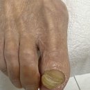 레푸스앤스타일 일산장항점 | 일산 발톱무좀 80대 어르신도 통증 없이! 일산레푸스, 레푸스 일산장항점 후기