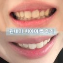 예쁜턱치과기공소 | 신사역 치아미백 성지 레브치과에서 누런이 고민 해결, 내돈내산 정보 공유
