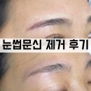 유월브로우 | 반영구 시술 후 빨간눈썹, 자연스럽게 지우는 방법 공개! 붉은잔흔 제거 후기 이천잔흔 여주잔흔