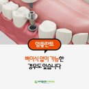 춘천클라인치과의원 | 임플란트, 뼈이식 없이 가능한 경우도 있습니다 (춘천내이플란트치과)