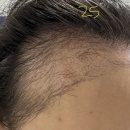 대망14-1낙차공 | [모발이식] 여자 헤어라인 절개 모발이식 내돈내산 후기: 1개월차 암흑기+후두부 켈로이드