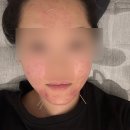 후한의원 | 수원 여드름피부과 후한의원 후기(3)