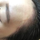 수아헤어라인 네이버블로그
