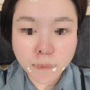 속시원한연합의원 | [제로피부과의원]강남역피부과 염증주사 후기! 아프지만 속 시원한 내돈내산 찐 방문기 💉✨